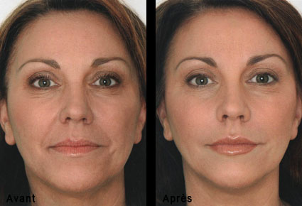 Injections d'acide hyaluronique au visage